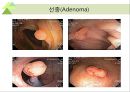 대장내시경에서 발견되는 소견 (대장 용종 및 대장암, 기타 소견).ppt 26페이지