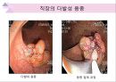 대장내시경에서 발견되는 소견 (대장 용종 및 대장암, 기타 소견).ppt 47페이지