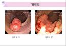 대장내시경에서 발견되는 소견 (대장 용종 및 대장암, 기타 소견).ppt 51페이지