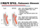 [의학] 선천성 심장질환[Congenital heart disease]에 관해 16페이지