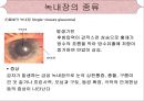[의학간호학기초] 시각장애  - 녹내장 11페이지