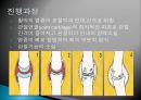 [질환별 물리치료] 무릎 류마티스관절염[Knee RA] 8페이지