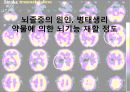 뇌졸중 전반조사 (해부/병태생리/약물/치료개발동향).ppt 1페이지