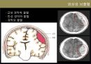 뇌졸중 전반조사 (해부/병태생리/약물/치료개발동향).ppt 8페이지