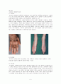 [간호과] 류마티스관절염(Rheumatoid Arthritis) 케이스 스터디 5페이지
