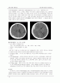 [간호학과] NSICU(신경외과중환자실) acute SDH (급성 경막하 혈종・출혈/Acute Subdural Hematoma, Hemorrhage) 케이스 스터디 (case study) 3페이지