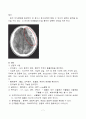 SDH(경막하출혈, 경막하혈종) 사례연구 7페이지