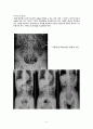 장폐색(intestinal obstruction) 간호과정 보고서  3페이지