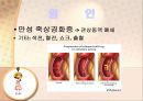 심근경색 (Myocardial Infarction).PPT자료 5페이지