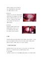 [여성간호] 여성간호 자궁근종 (myoma uteri) 케이스 스터디 14페이지