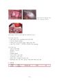 [여성 간호학][Ovarian cyst][난소난종]케이스 스터디(Case Study), 문헌고찰 13페이지