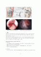 [성인간호학][ACL rupture][십자인대파열][Anterior cruciate ligament rupture] 케이스 스터디(Case Study), 문헌고찰 4페이지