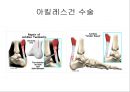 아킬레스 건염 재활 운동 (Achilles Tendinitis 정의, 원인, 진단, 분류, Paratenonitis(건주위염)치료, Tendinosis(퇴행성 건염) 치료, Achilles Tendon Rupture 정의, 증상, 아킬레스건 수술, 재활 운동).PPT자료 23페이지