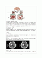 [성인간호학] 응급실 뇌출혈 케이스 스터디 (Cerebral hemorrhage case study) 3페이지