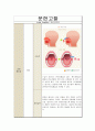 [아동간호학] 급성편도염 Acute Tonsilitis 실습 케이스스터디 5페이지