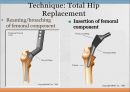 THRA PPT Anatomy 와 관련질환 수술방법  20페이지