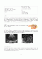 자궁내막암(Endometrial cancer) 케이스 4페이지