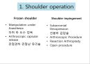 회선근개 재활 운동 (어깨 수술의 이해 Shoulder operation, 어깨 재활 운동 0~2주 재활운동, ROM Exercise, 스트레칭 Stretching, Simple EX 10분).PPT자료 3페이지
