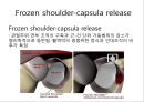회선근개 재활 운동 (어깨 수술의 이해 Shoulder operation, 어깨 재활 운동 0~2주 재활운동, ROM Exercise, 스트레칭 Stretching, Simple EX 10분).PPT자료 11페이지