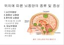 뇌종양종류 및 증상,양성종양 VS 악성종양,뇌종양 수술 방법,뇌종양에 좋은 음식,뇌농양,두부손상,두부손상 응급처치,두부손상에 의한 질환 5페이지