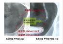 비뇨기계 질환과 간호 (신장 결석, 요관결석, 요로감염, 신장암, 방광염, 방광암, 과민성 방광, 요실금, 방광 결석, 방광요관역류, 전립선 비대증, 전립선염, 전립선 암, 음낭 질환, 고환암, 요도 협착).pptx 18페이지