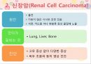 비뇨기계 질환과 간호 (신장 결석, 요관결석, 요로감염, 신장암, 방광염, 방광암, 과민성 방광, 요실금, 방광 결석, 방광요관역류, 전립선 비대증, 전립선염, 전립선 암, 음낭 질환, 고환암, 요도 협착).pptx 28페이지