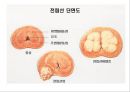 비뇨기계 질환과 간호 (신장 결석, 요관결석, 요로감염, 신장암, 방광염, 방광암, 과민성 방광, 요실금, 방광 결석, 방광요관역류, 전립선 비대증, 전립선염, 전립선 암, 음낭 질환, 고환암, 요도 협착).pptx 84페이지