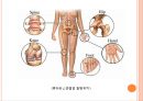 [운동처방관련학과] 류마티스성 관절염(RA)  - 특징, 진행과정, 영향 , 류마티스성 관절염과 운동, 운동처방 9페이지