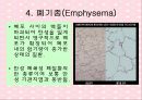 노화와 관련된 호흡기계변화(천식, COPD, 만성기관지염, 폐기종, 폐렴, 질환에 따른 간호) 16페이지