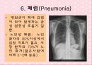 노화와 관련된 호흡기계변화(천식, COPD, 만성기관지염, 폐기종, 폐렴, 질환에 따른 간호) 22페이지