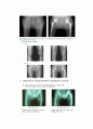 고관절 반치환술 (Bipolar Hemiarthroplasty) & 전치환술 (THR)

 17페이지