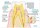 [치주질환 (periodontal disease)] 치주질환 정의, 치주질환 종류, 치주질환 원인, 치주질환 증상, 치주질환 치료.ppt 5페이지