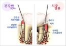 [치주질환 (periodontal disease)] 치주질환 정의, 치주질환 종류, 치주질환 원인, 치주질환 증상, 치주질환 치료.ppt 13페이지