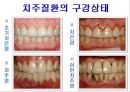 [치주질환 (periodontal disease)] 치주질환 정의, 치주질환 종류, 치주질환 원인, 치주질환 증상, 치주질환 치료.ppt 14페이지