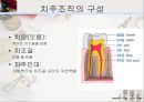 [치주질환 (periodontal disease)] 치주질환 정의, 치주질환 종류, 치주질환 원인, 치주질환 증상, 치주질환 치료.ppt 15페이지