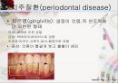 [치주질환 (periodontal disease)] 치주질환 정의, 치주질환 종류, 치주질환 원인, 치주질환 증상, 치주질환 치료.ppt 18페이지