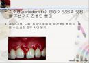 [치주질환 (periodontal disease)] 치주질환 정의, 치주질환 종류, 치주질환 원인, 치주질환 증상, 치주질환 치료.ppt 19페이지
