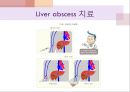 간농양 ppt (liver abscess ) 13페이지