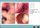 위장관 출혈 GI Bleeding 문헌고찰 정의 병태생리 증상 치료 간호과정 3개 9페이지