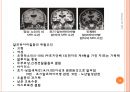 [노인간호학, 노인간호중재] 노인성 특수장애, 치매, 노인자살, 낙상 18페이지