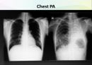 호흡곤란(COPD) 사례관리 케이스 7페이지