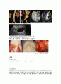 성인간호학실습, 성인간호, 케이스스터디, case study 복부대동맥류(abdominal aortic aneurysm) (AAA) 간호진단 2개 5페이지