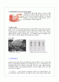 성인간호학 전립선암(Malignant neoplasm of prostate) Case study 4페이지