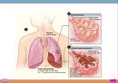 폐렴, 폐렴정의, 폐렴분류, 폐렴병태생리, 폐렴빈도, 폐렴위험요인, 폐렴증상, 폐렴치료, 폐렴합병증, 폐렴예후, 폐렴 케이스스터디, ICU Case Study, Pneumonia, 10페이지