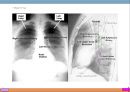 폐렴, 폐렴정의, 폐렴분류, 폐렴병태생리, 폐렴빈도, 폐렴위험요인, 폐렴증상, 폐렴치료, 폐렴합병증, 폐렴예후, 폐렴 케이스스터디, ICU Case Study, Pneumonia, 11페이지