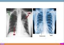 폐렴, 폐렴정의, 폐렴분류, 폐렴병태생리, 폐렴빈도, 폐렴위험요인, 폐렴증상, 폐렴치료, 폐렴합병증, 폐렴예후, 폐렴 케이스스터디, ICU Case Study, Pneumonia, 12페이지