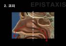 응급간호학 코피 epistaxis 비골 골절 nasal bone fracture 발표 자료 4페이지