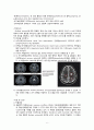 [성인] 다발성 경화증(Multiple sclerosis) 문헌고찰 및 간호과정 7페이지