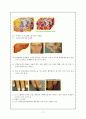 강추) 후회노) 내과case - 간세포암 Hepatocellular Carcinoma A++ CASE STDY, 케이스스터디, 17페이지