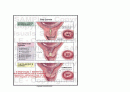 [여성간호] 자궁근무력증(IIOC) 병태생리 3페이지